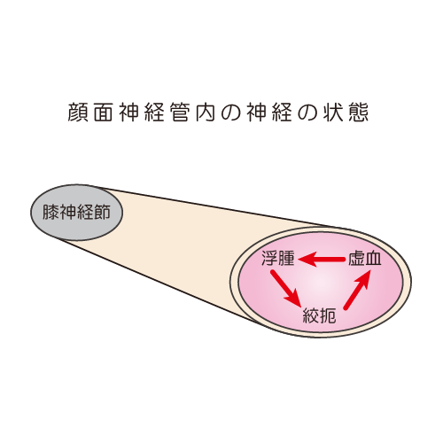 顔面神経麻痺の神経変性