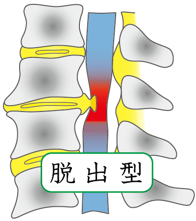 脱出型ヘルニア
