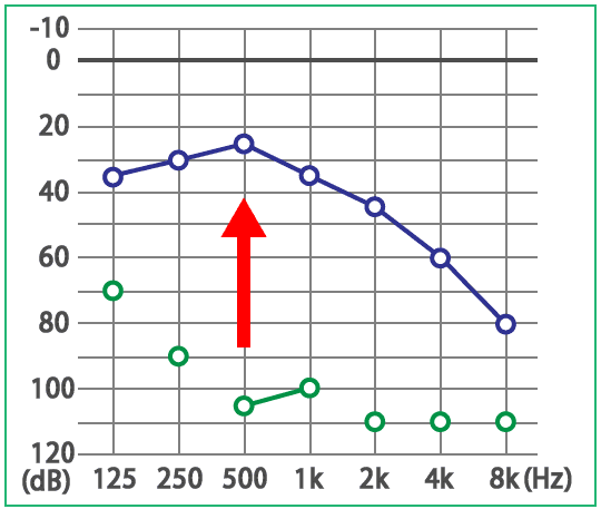 めまい・メニエール病・PPPD