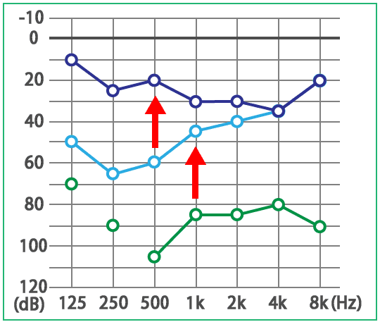 めまい・メニエール病・PPPD