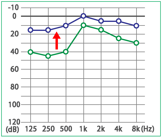 めまい・メニエール病・PPPD