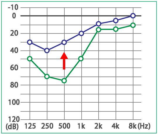 めまい・メニエール病・PPPD