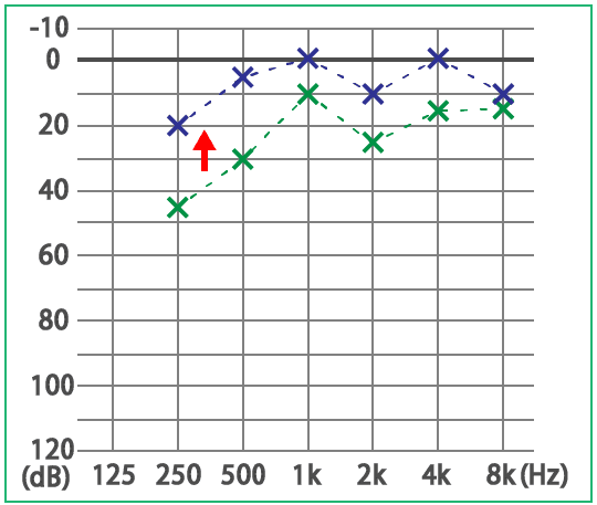 めまい・メニエール病・PPPD