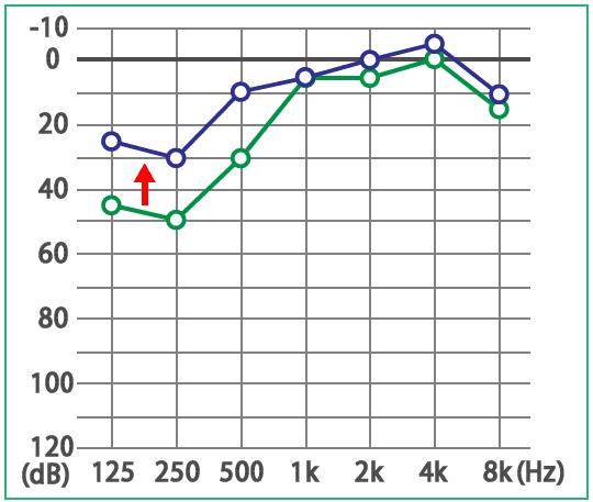 めまい・メニエール病・PPPD