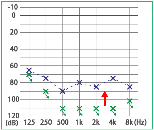 めまい・メニエール病・PPPD