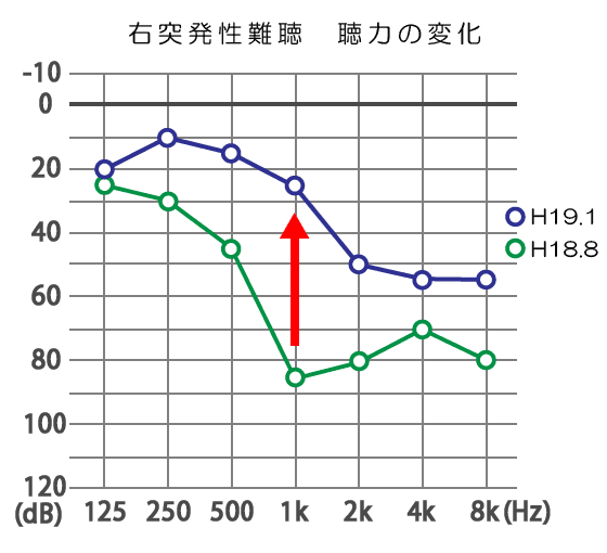 突発性難聴の聴力変化
