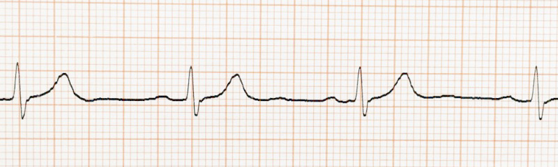 自律神経失調症と心電図