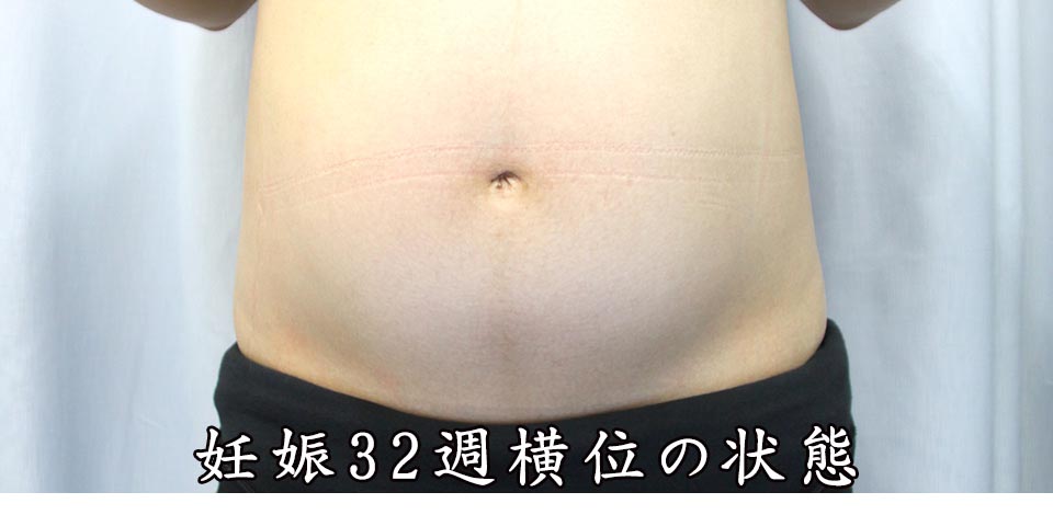 妊娠32週逆子体操で治らないときの治し方