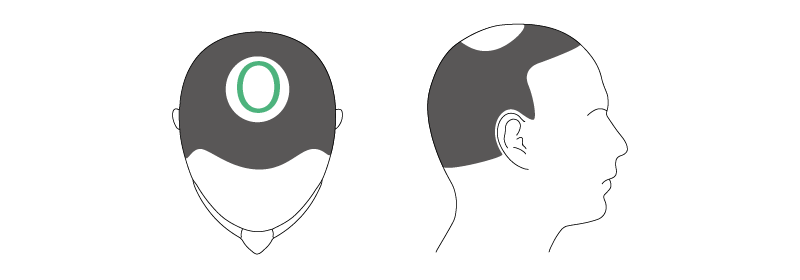 O字ザビエルハゲ