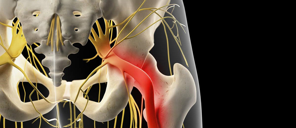 坐骨神経痛の治療